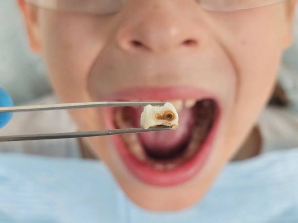 Best Chipped Tooth Repair Near Me  in Paducah, KY